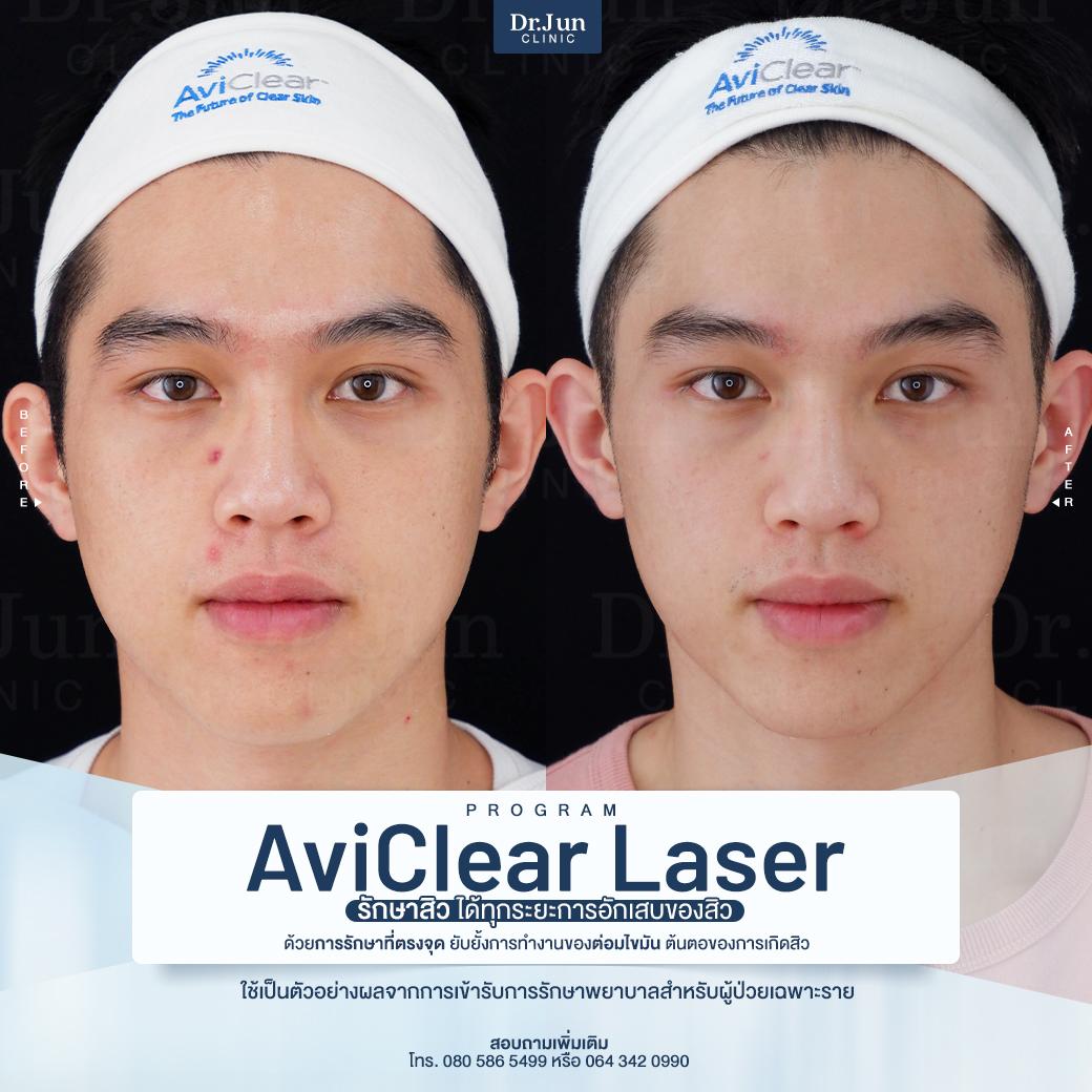 รีวิว AviClear Laser