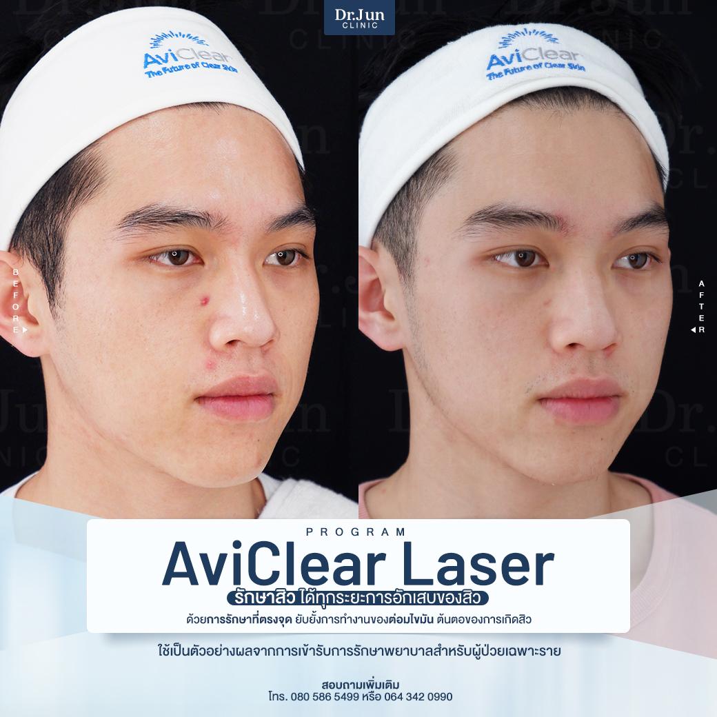รีวิว AviClear Laser