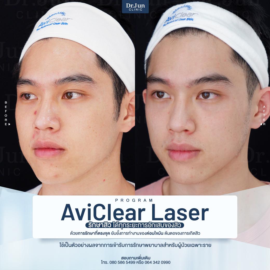 รีวิว AviClear Laser