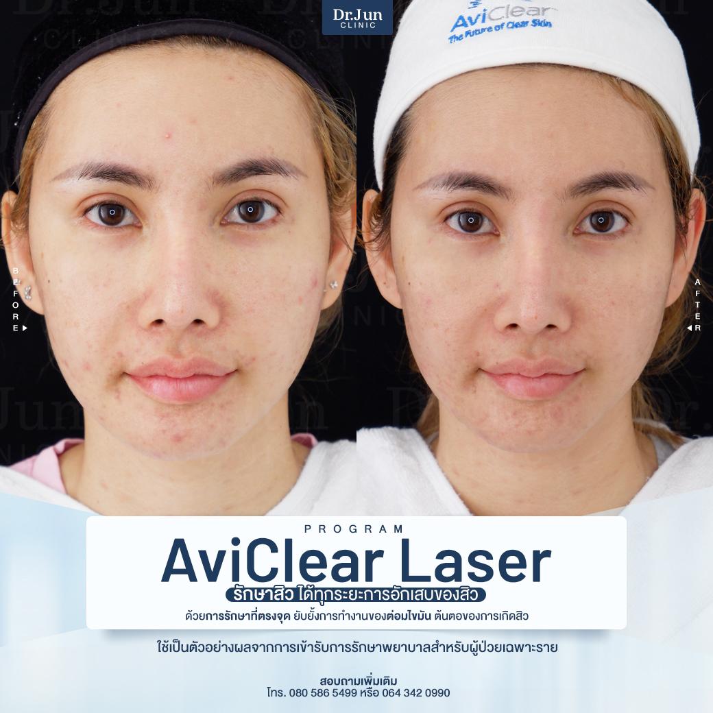 รีวิว AviClear Laser
