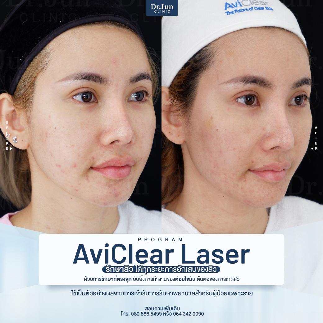 รีวิว AviClear Laser