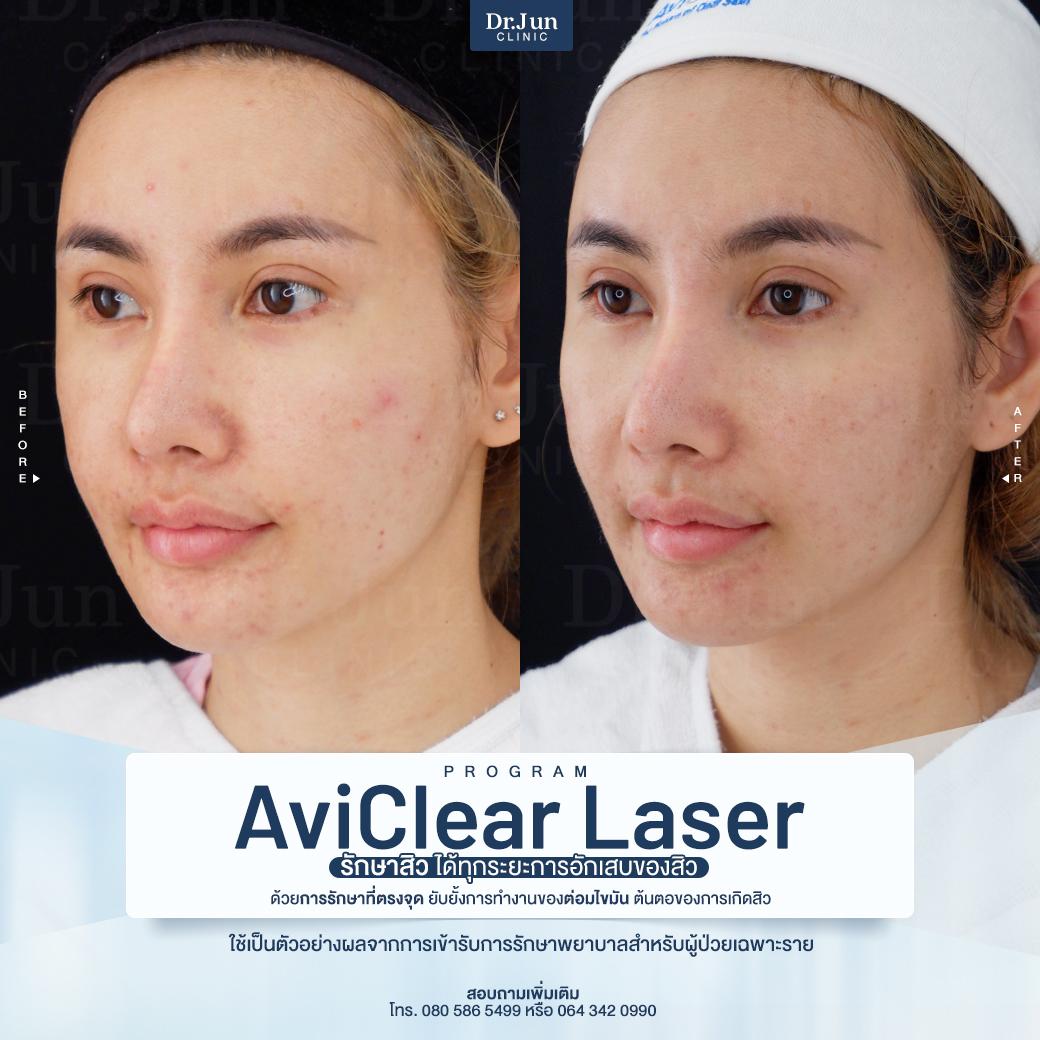 รีวิว AviClear Laser