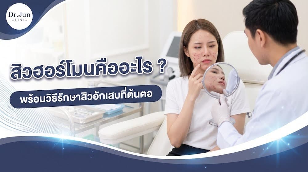 สิวฮอร์โมนคืออะไร พร้อมวิธีรักษาสิวอักเสบที่ต้นตอ